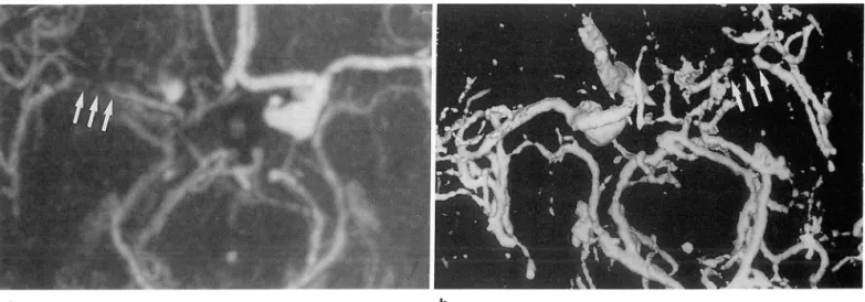Fig.  3.  Tapering-off  effect  of  transversely  oriented  thin  vessels.  The  transversely  oriented  segment(M1 )(arrows)  of  right  middle  cerebral  artery with  vasospasm  is  tapered  and  disappeared  on  the  MIP(a)  and  SSD(b)  images  of CTA 