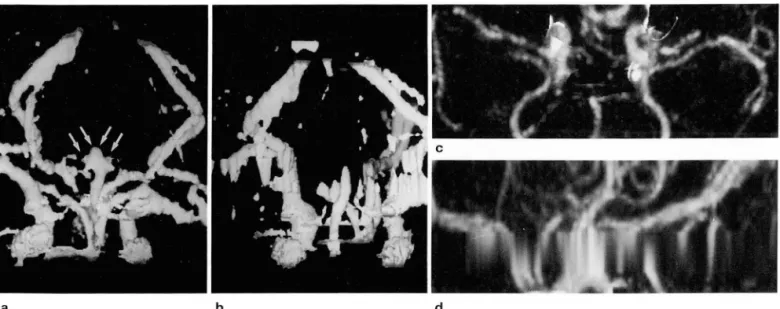 Fig.  5.  Break-off or  blurring  by  misreconstruction.  The  proximal  portion  01  both  posterior cerebral  artery and  distal  basilar  artery  (arrows)  demonstrated  on  the  corrected  SSD  image (a)  is  not seen  or  severely  blurred  and  disto