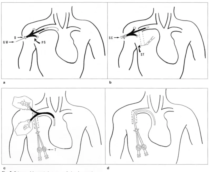 Fig.  2 . Schema of the  central  venous  catheter  placement 