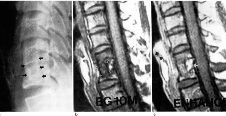 Fig . 1.  A  44-year-old  man  with  anterior cervical  lusion(bone  graft)  after lall  down  a