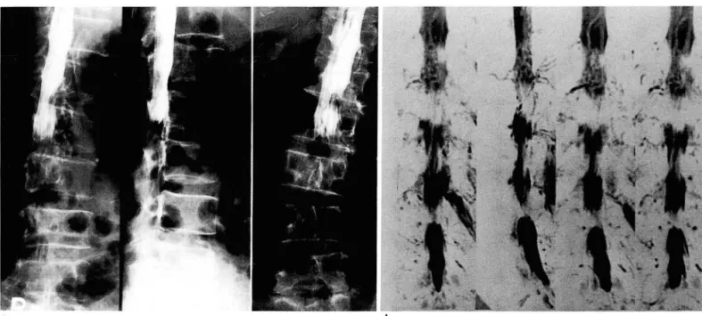 Fig.  2.  With  complete  block  at  L2-3  level ,  thecal  sac  below the  block  level  is  not  well  delineated  on  conventional  myelogram(a)  In  contrast , MR  myelogram(b)  well  delineates thecal  sac  below the  block