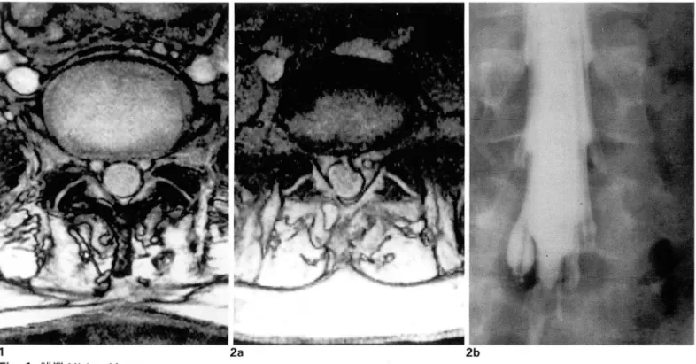 Fig . 2a.  미운  Mickey  Mouse:  co미 oined  nerve  root  in  R t.  side  Fig.  2b.  Myelogram  01  the conjoined  nerve  root in  R t