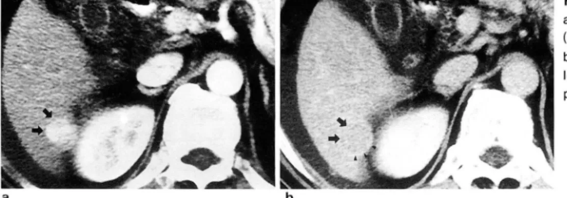 Fig.  1.  a.  Early  phase  CT  scan  shows  a  high  attenuating ,  2cm  sized  mass  (arrows)  in  right  lobe  of  the liver  b