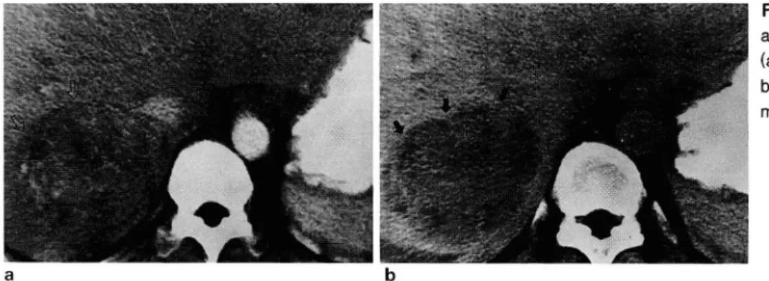 Fig.  2. a.  Early  phase  CT  scan  shows  a  mixed  attenuating ,  7cm  sized  mass  (arrows)  in  right  lobe  of  the  I iver