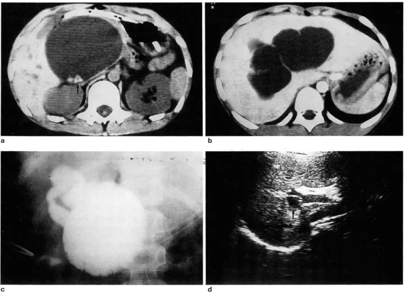 Fig.  5.  Type  lVa  choledochal  cyst 