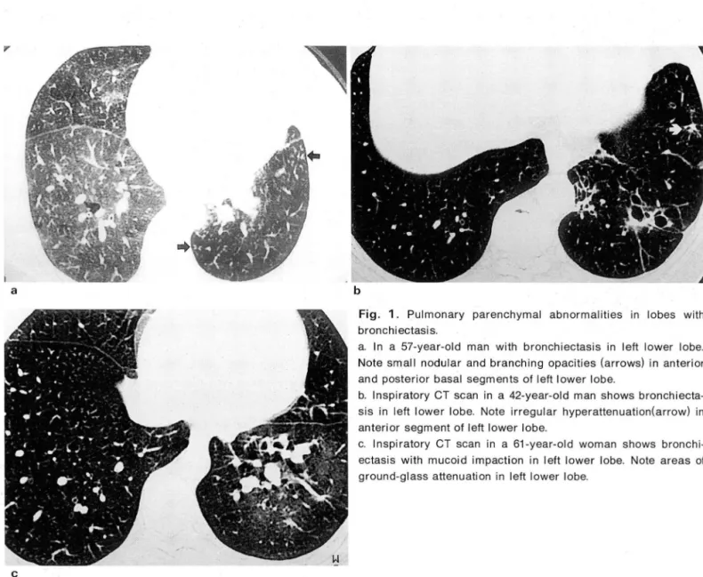 Fig.  1 .  Pulmonary  parenchymal  abnormalities  in  lobes  with  bronchiectasis 