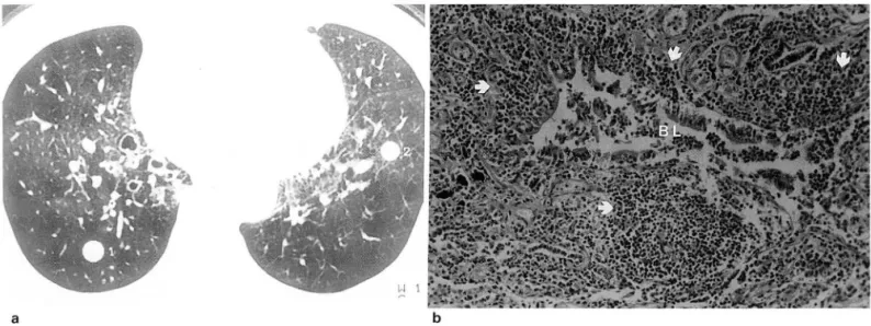 Fig . 2.  A  45-year-old  man  with  bronchiectasis  in  right lower lobe 