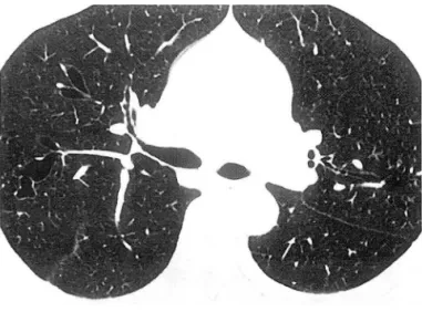 Fig.  3.  A  36-year-old  woman  with  bronchiectasis 