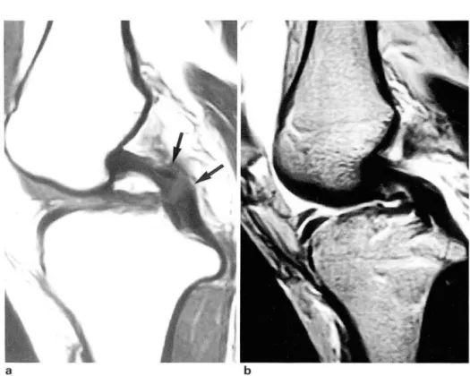 Fig.  3.  The  importan ce 01  T2-weighted im- im-age  in  the  evaluation  01  the PCL 