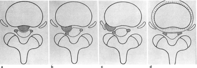 Fig.  1. Schematic  diagram  01  various types  01  disc  herniation 