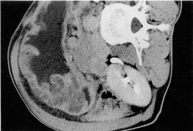 Fig.  2.  a.  CT  scan  shows  a  thick-walled  mass  in  gastric  body  containing  mottled  calcifications(arrows)  within  low  attenuation  area ‘  b