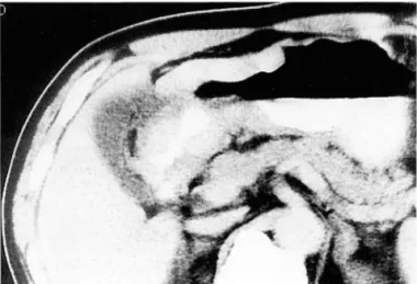 Fig.  4.  CT  scan  shows  a thick-walled  mass containing  mottled  calcifications(arrows)  within  low  attenuation  area in  cecum