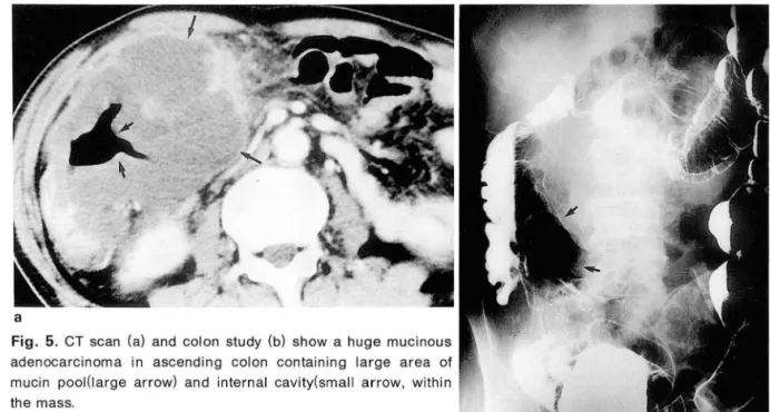 Fig.  5.  CT  scan  (a)  and  colon  study  (비  show  a  huge  mucinous  adenocarcinoma  in  ascending  colon  containing  large  area  01  mucin  pool(large  arrow)  and  internal  cavity(small  arrow ,  withi n  the  mass