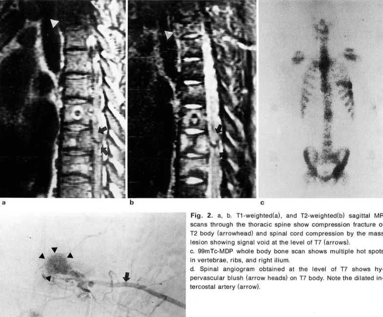 Fig.  2.  a,  b.  T1-weighted(a) ,  and  T2-weighted(b)  sagittal  MR  scans  through  the  thoracic  spine  show  compression  fracture  of  T2  body  (arrowhead)  and  spinal  cord  compression  by  the  mass  lesion  showing  signal  void  at  the  leve
