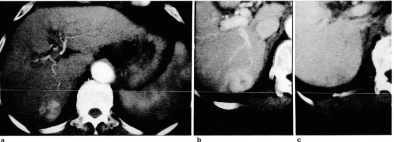Table  3.  Enhancement  Pattern  of  Hepatic  Metastases  on 
