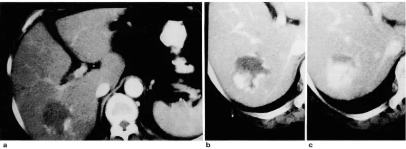 Fig.  3.  66-year-old  female  with  hemangioma 
