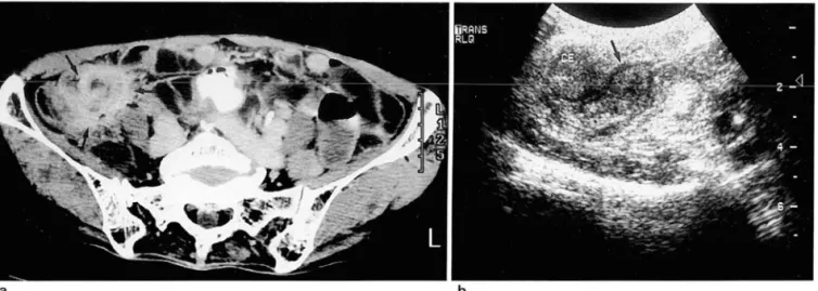 Fig.  3.  Perlorated  appendicitis  with  pericecal  phlegmon 