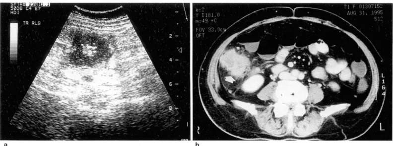 Fig . 5.  Ascending  colon  cancer  presenting  as  wall  thickening 