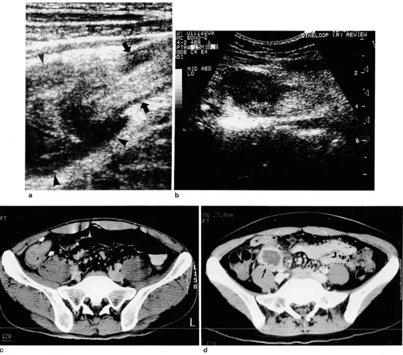 Fig.  7 .  Ileocecal(I-C)  tuberculosis 