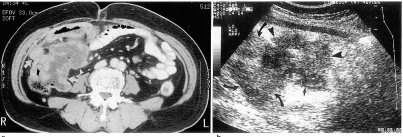 Fig.  8.  Perforated cecal  cancer 