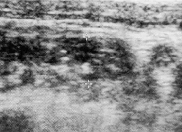 Fig.  1.  Nonperforated  appendicitis.  On  a  transeverse  scan ,  the  appendix(clipper)  has a target appearance 