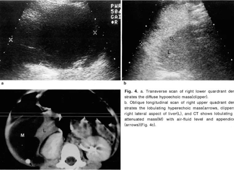 Fig.  4.  a.  Transverse  scan  of  right  lower  quardrant  demon- demon-strates  the  diffuse  hypoechoic  mass(clipper) 