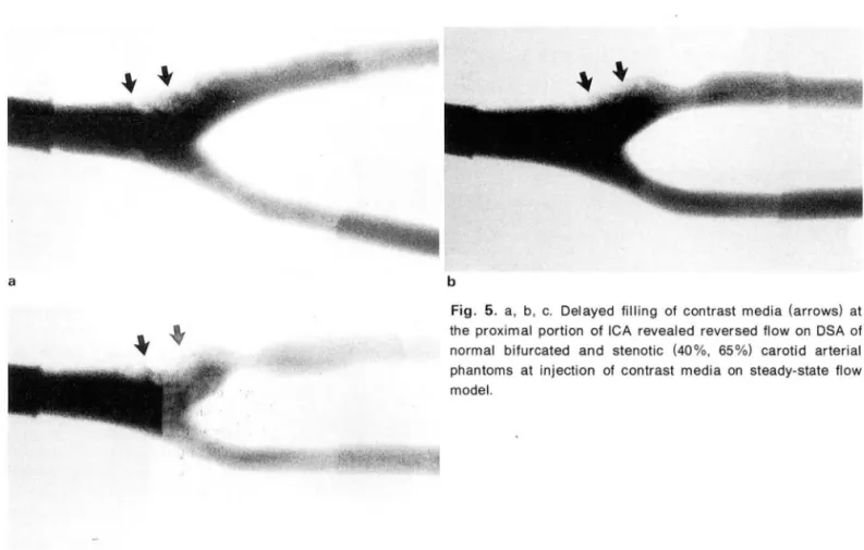 Fig.  5.  a,  b , c.  Delayed  lilling  01  contrast  media  (arrows)  at  the  proximal  portion  01  ICA  revealed  reversed  flow  on  DSA  01  normal  bilurcated  and  stenotic  (40% ,  65 %)  carotid  arterial  phantoms  at  i 미 ection  01  contrast  