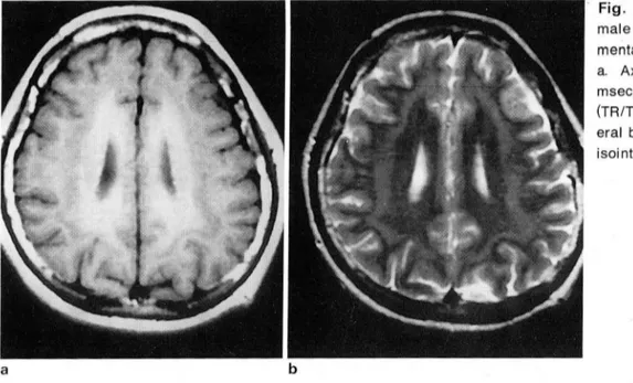 Fig .  2.  Heterotopias.  This  17-year-old  le- le-male  had  generalized  type  seizures  and  mental  retardation 