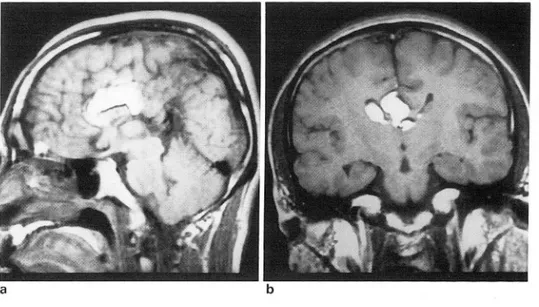 Fig.  4.  Agenesis  of  the  corpus  callosum  associated  with  a  lipoma.  This  26-year-old  patient complained  of  mild  headache  a