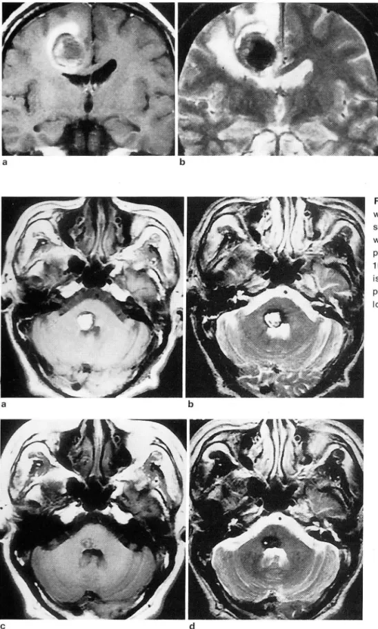 Fig .  2.  Type  I  lesion.  A  41-year.old  male  with  attacks  01  left  hemiparesis  lor  20  days 