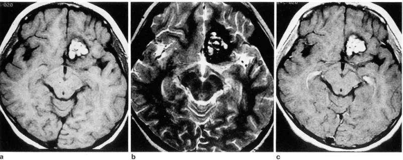 Fig.  4.  Typelll  lesion  in  a  9-year-old  male which  was  found  incidentally. 