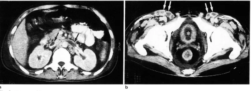 Fig.  3.  Photomicrograph  01  the  kidney  specimen  reveals  deposits  01  amyloid  primarily  in  the  glomeruli  (black  arrow)  and  the  interstitial  peritubular  tissue