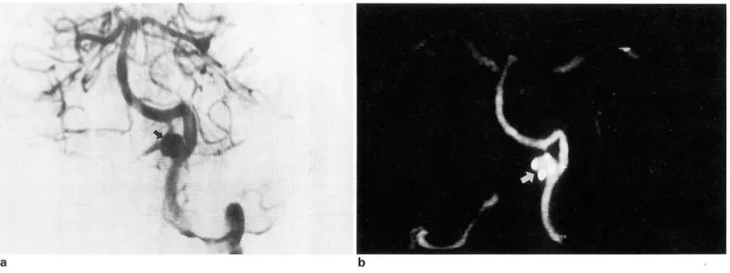 Fig.  1.  Vertebral  artery  aneurysm  with  calcification. 