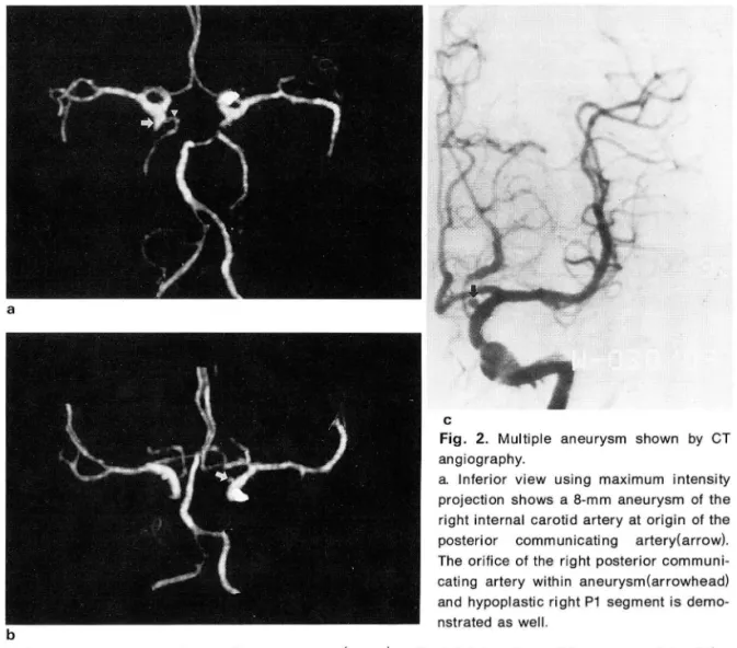 Fig.  2.  Multiple  aneurysm  shown  by  CT  angiography 