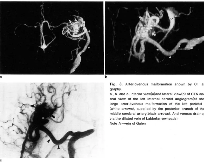Fig.  3.  Arteriovenous  malformation  shown  by  CT  angio- angio-graphy 