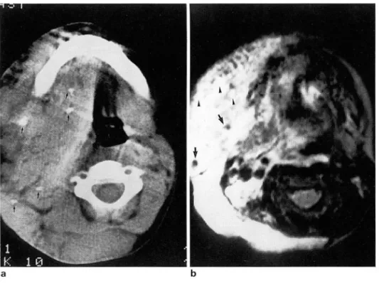 Fig.  2.  Venous  malformation(Case  No.  2)  a.  Multiple  phleboliths  (small  arrows)  as  calcific  densities  are  seen  in  a  large   ve-nous  malformation  of  the  right  neck  area 