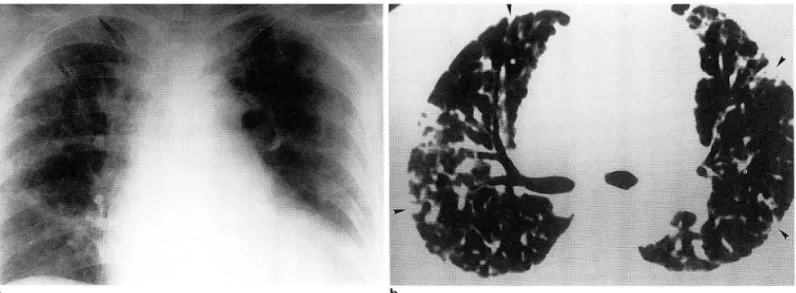 Fig.  2.  Case 5: A 65-year-old  woman  with  flame  burn(40%). 