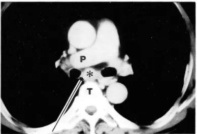 Fig.  3 .  CT  scan  01  subcarinal  mass  (asterisk).  The  mass  is  bounded  by  thoracic  vertebra  (T)  and  right  p비 monary  artery  (p) ‘  Long  arrow  indicates  the direction  01  biopsy  needle  in  the  oblique  approach  진단되였다