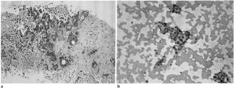 Fig.  2.  Cholangiocarcinoma 