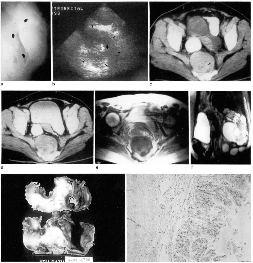 Fig .  1.  a.  80ft  tissue  density  mass  compressing  rectum  anteriorly(arrows)  is  seen  on  the  lateral  view  01  sacrum-coccyx  during  barium  enema