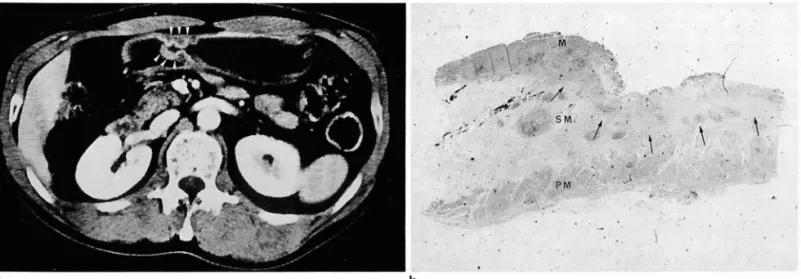 Fig.  2 . Type  1  enhancemenl  pattern  01  early gastric carcinoma  (type  11 1)  in  a  56-year-old  man 