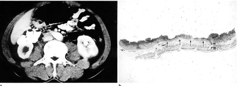 Fig .  5.  Type 3  enhancement  pattern  01  early  gastric cance r( type IIc)  in  59-year-old  man 