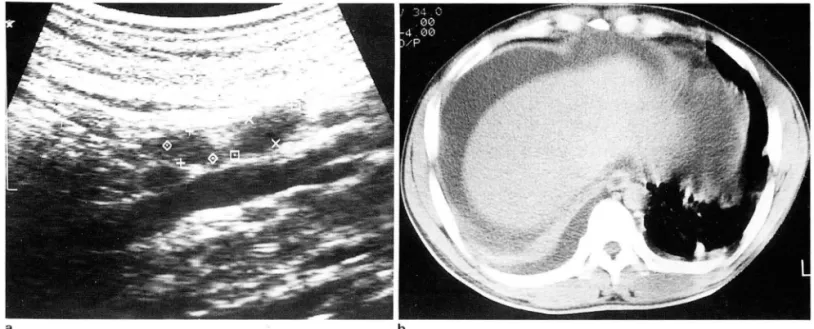 Fig.  2 .  A  36-year-ol d man  with  abdominal  form  of alimentary anthrax 