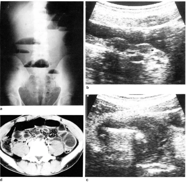 Fig.  3.  A  25-year-old  man  with  abdominal  lorm  01  alimentary  anthrax 