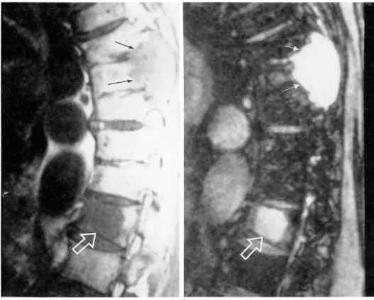 Fig.  6.  Metastatic  compression  fracture  with  paraspinal  mass  in  81-year-old  man  with  thyroid  cancer