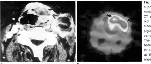 Fig.  1.  Squamous  cell  carcinoma  in  supraglottic  area  and  cervical  Iymph  node 