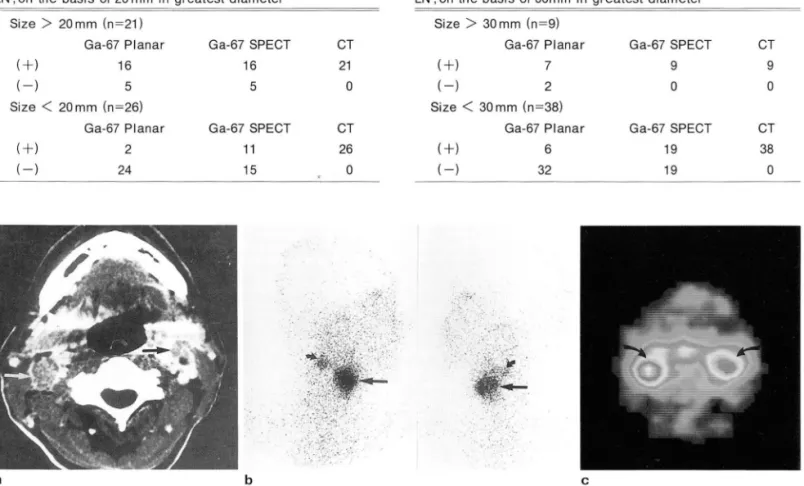 Table  2.  Gallium  Scan  versus CT Lesion  Detection  of  Cervical  LN ;  on  the  basis  of 30mm  in  greatest  diameter 
