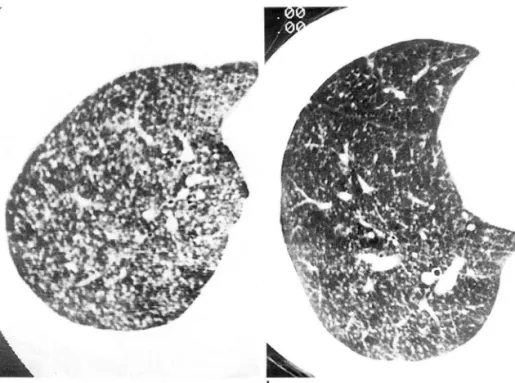 Fig.  1.  Distribution  01  nodules  in  miliary  pulmonary  tuberculosis. 