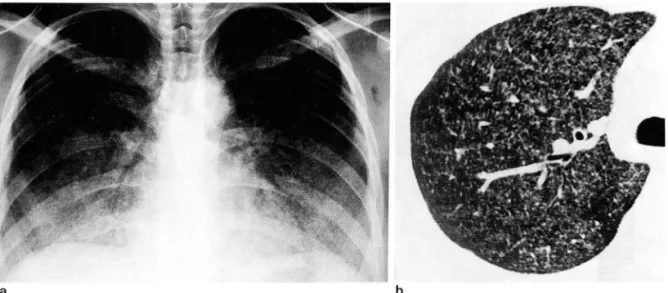 Fig.  4.  Miliary pulmonary  tuberculosis  associated  with  ARDS 