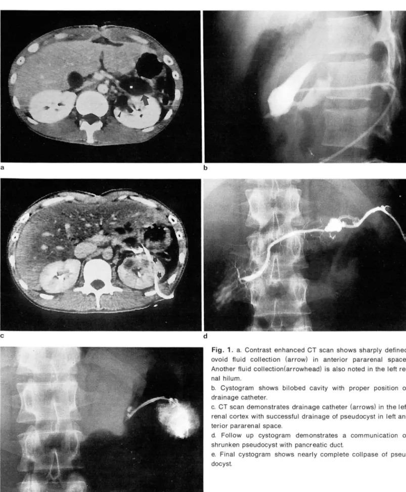 Fig .  1.  a.  Contrast  enhanced  CT  scan  shows  sharply  defined 